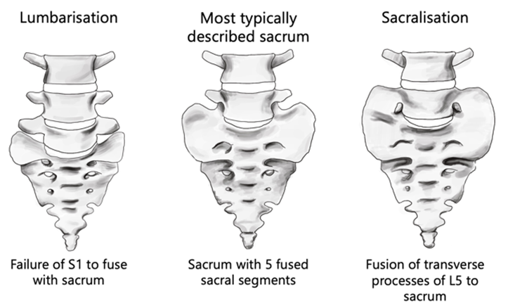 Ventral surface of sacrum showing Partial Lumbarisation of first