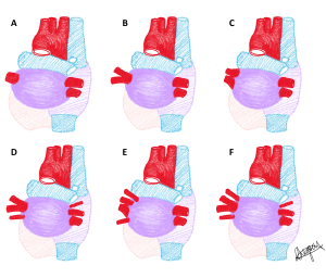 A: Type I on left. B: Type IIA on right and Type IIB on left. C: Type IIA on left and right, demonstrating most frequent phenotype reported in most populations. D: Type IIIA on right and Type IIIB on left. E: Type IVA on left. F: Type IVB on left.