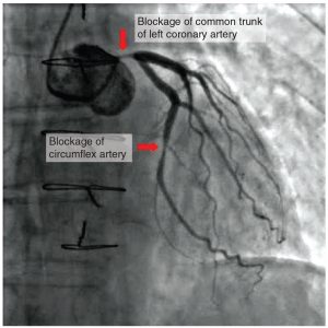 Chapter 6: THE CARDIOVASCULAR SYSTEM: THE HEART – Anatomy & Physiology