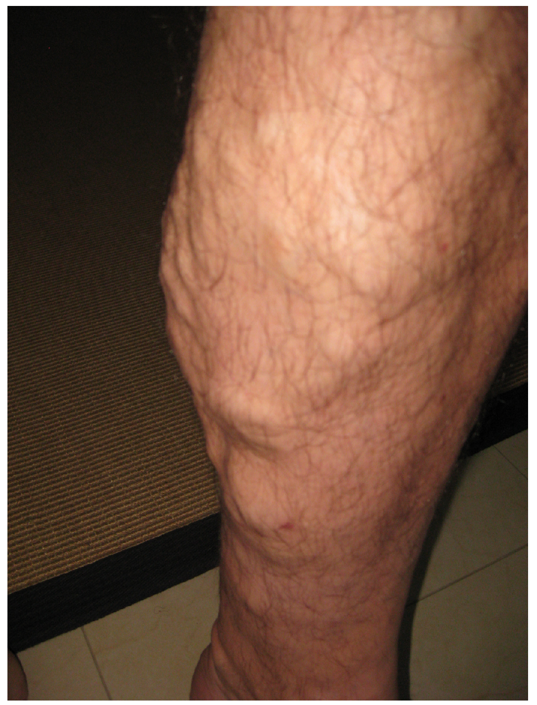 Photograph of patient's varicose veins